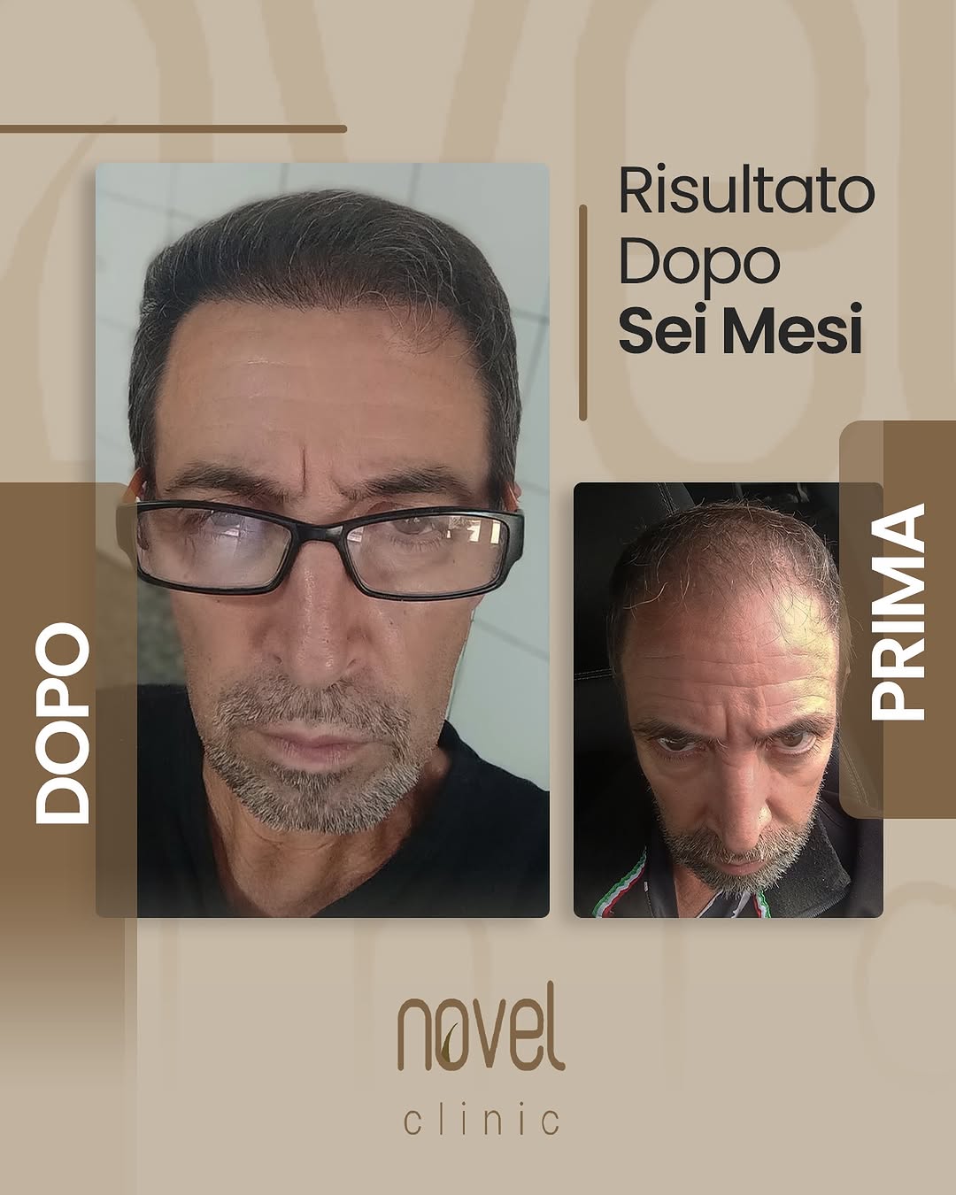 Paziente Novel Clinic: confronto prima e dopo, risultato a 6 mesi