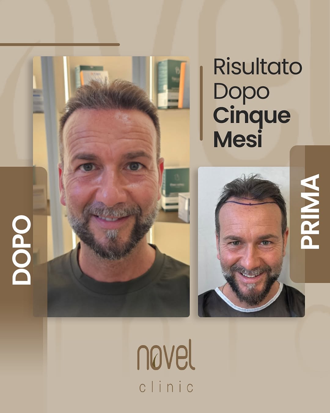 Paziente Novel Clinic: confronto prima e dopo, risultato a 5 mesi