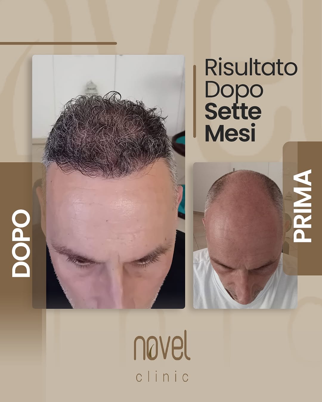 Paziente Novel Clinic: confronto prima e dopo, risultato a 7 mesi