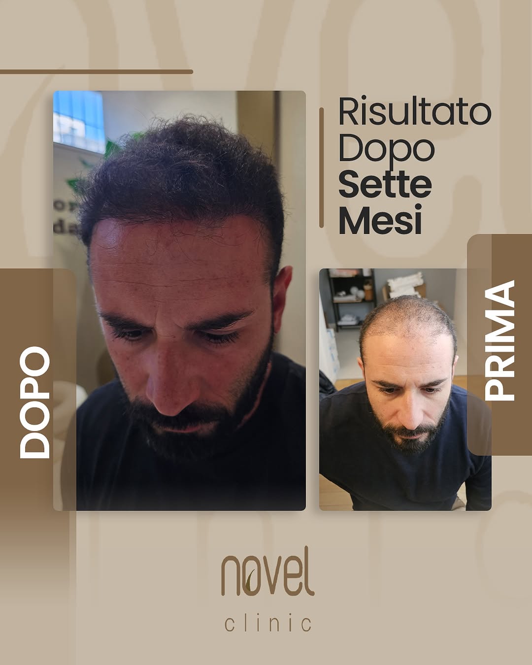 Paziente Novel Clinic: confronto prima e dopo, risultato a 7 mesi