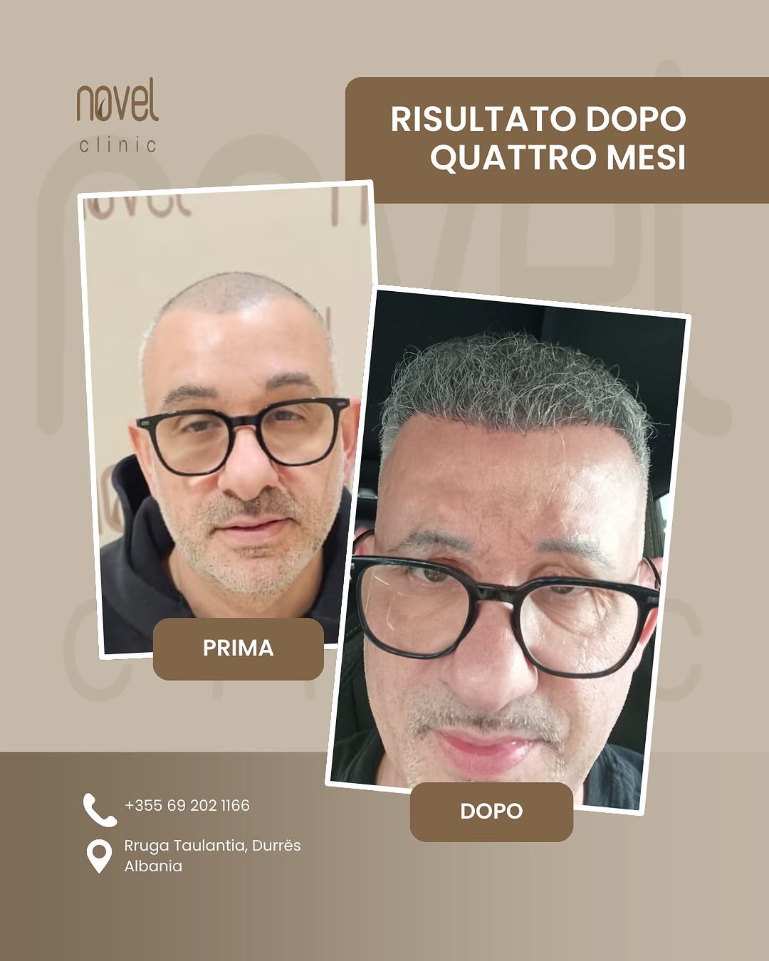 Paziente Novel Clinic: confronto prima e dopo, risultato a 4 mesi